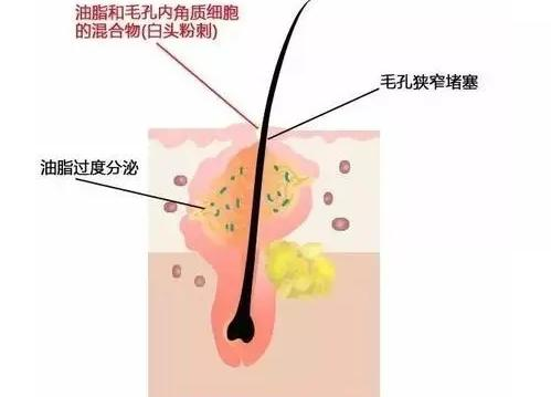内分泌失调促使皮脂分泌过多 无法排出而阻塞毛囊,为青春痘的产生创造
