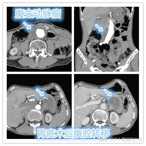 急腹痛远不止你想的那么简单:胃癌术后复发合并腹主动脉瘤!