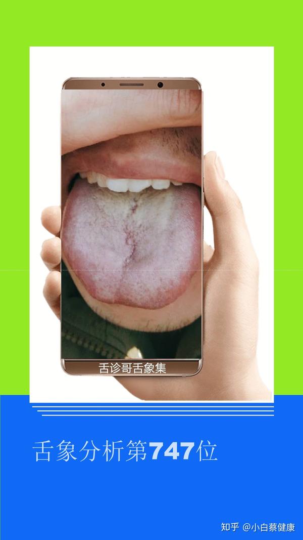 舌诊哥舌象分析舌头脾虚胀大早上起床嘴巴发干发苦大便粘腻