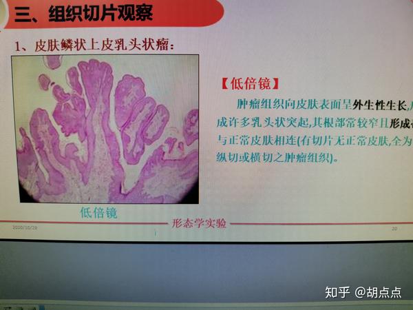 鳞状细胞癌低分化鳞状细胞癌直肠腺癌平滑肌瘤平滑肌肉瘤病理组织切片