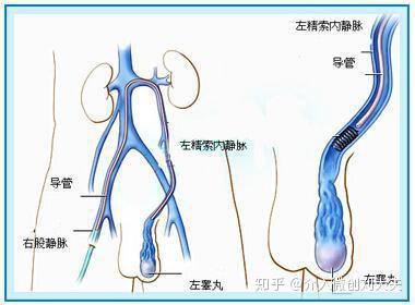 使用 弹簧圈 泡沫硬化剂对靶血管进行硬化栓塞治疗,从而达到闭塞精索