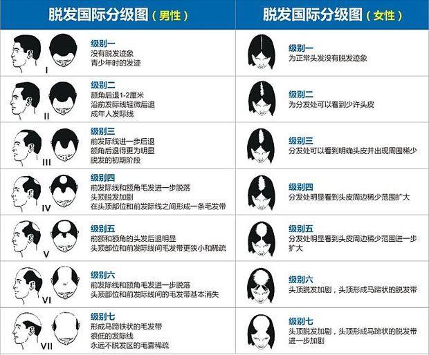 脱发有等级莫陷入误区