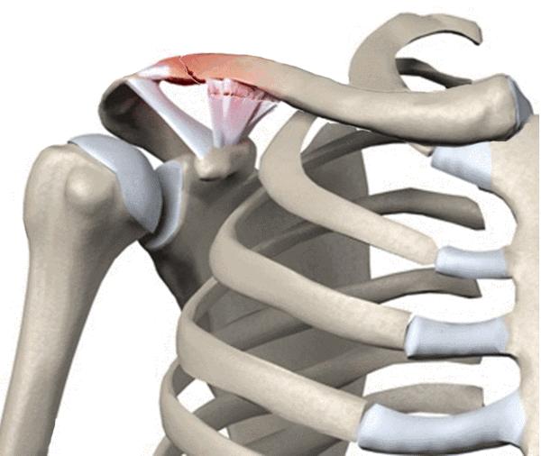 4,成人:骨折移位小于1cm的锁骨骨折通常不用手术,用锁骨固定带固定6