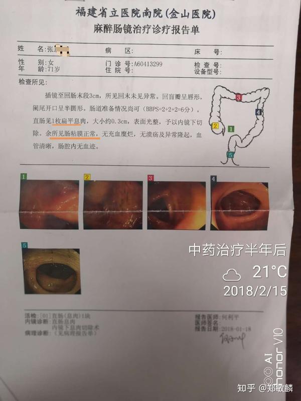 《郑敏麟医案》:萎缩性胃炎伴肠化,直肠多发息肉兼失眠案