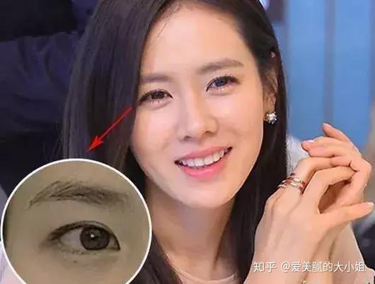 割双眼皮对外貌的改变大吗