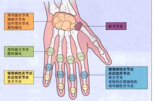 不可忽视的银屑病(牛皮癣)关节炎