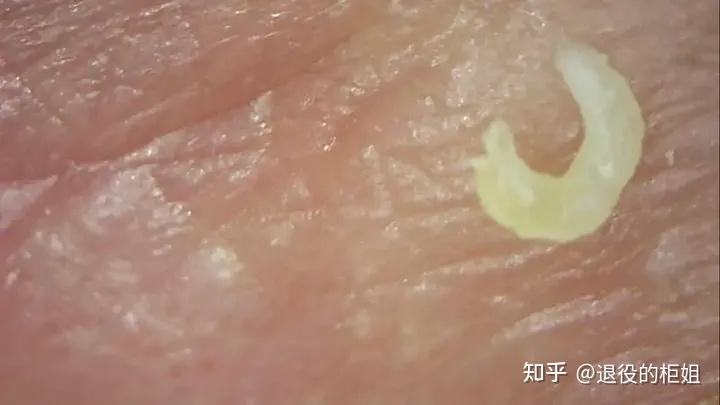 痘痘里面白色的是什么