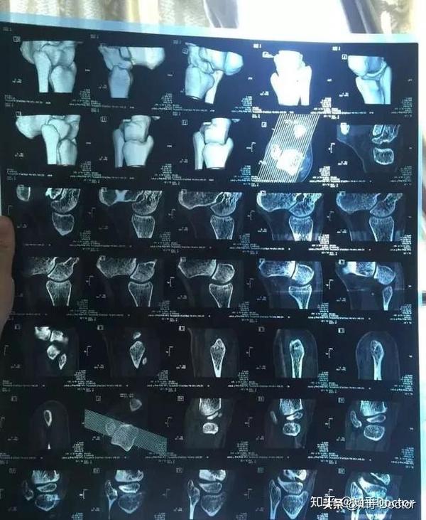 骨折拍了x线,为什么还要做ct和mri?