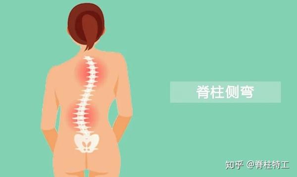 脊柱侧弯的5大常见误解(持续更新)