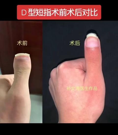 d型短指症 知乎