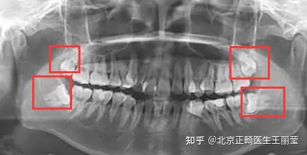 牙齿矫正过程中,智齿只会帮倒忙?