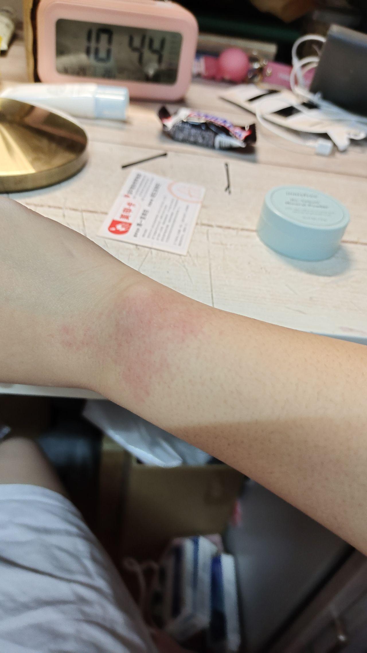 用脱毛膏脱毛后皮肤变成这样怎么办