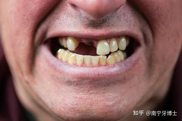 细数缺牙八宗罪缺牙修复刻不容缓