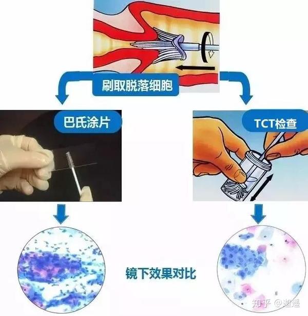 tct检查 与传统的宫颈刮片"巴氏涂片"检查相比,tct检查明显提高了