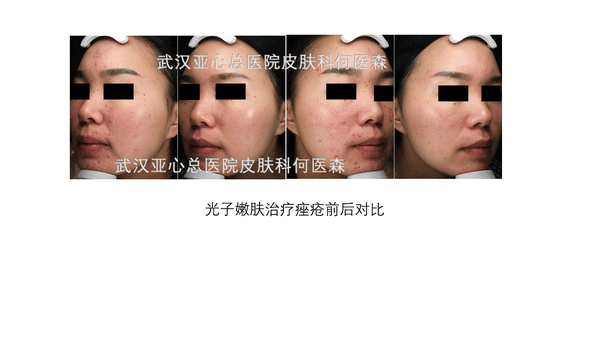 光子嫩肤——超全能入门级医美项目,超燃