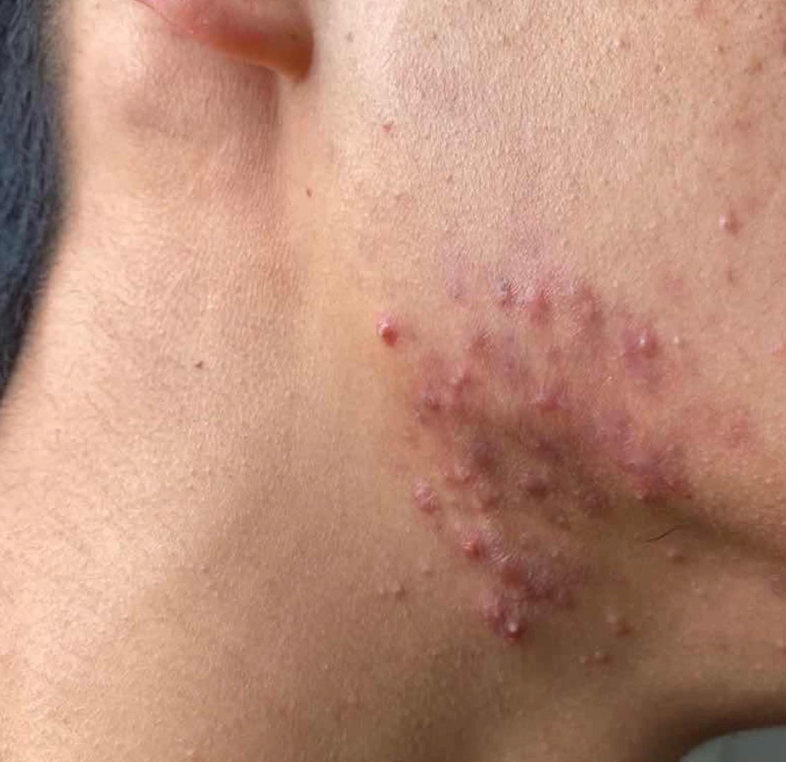 脸和下颌交界处的痘痘怎么办啊?