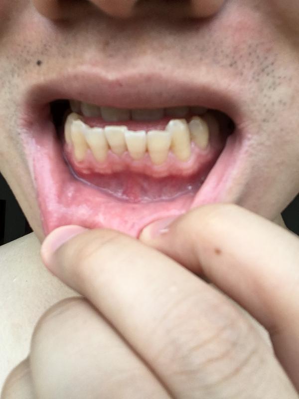 牙齿错乱,牙龈萎缩,怎么办?