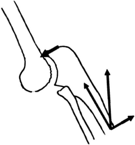 环状韧带和尺桡骨近侧骨间膜被劈裂,造成桡骨头向前方脱位,而尺骨近