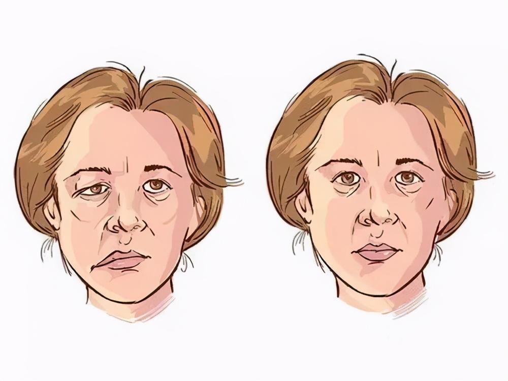 性面神经炎,是指面部表情肌肉的运动功能发生障碍,导致出现口角歪斜