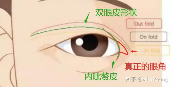 因为真正的眼角位置(双眼皮的起始位置)被内眦赘皮遮盖住,所以双眼皮