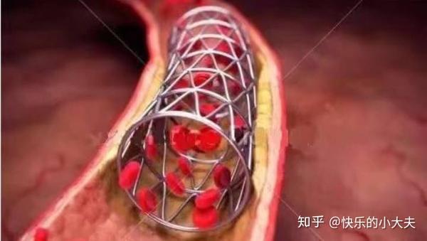 心脏支架术后一年还需要再做造影检查吗