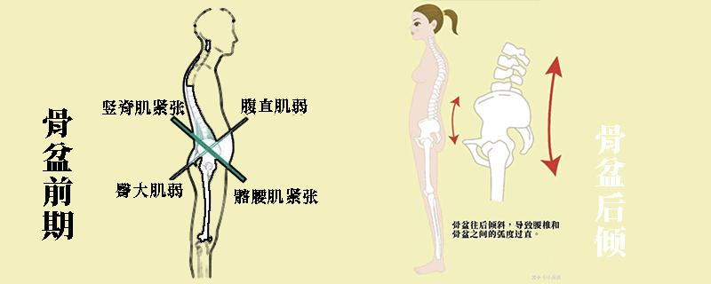 骨盆前倾和后倾傻傻分不清?一文搞懂这俩体态问题的异同