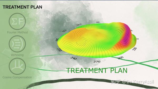 结合了角膜地形图与全眼像差的idesign平台的精准测量,为个性化治疗