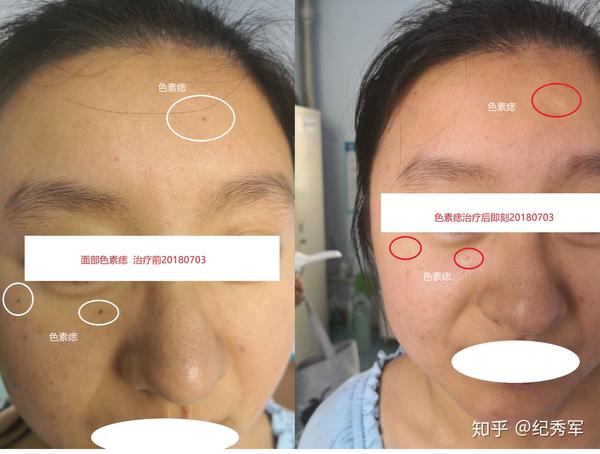 色素痣治疗前后对比图