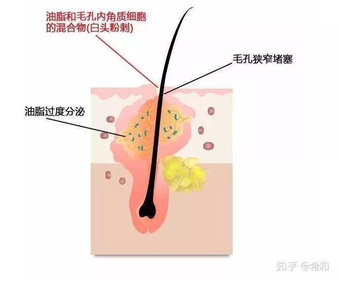 b. 毛囊皮脂腺导管的异常角化