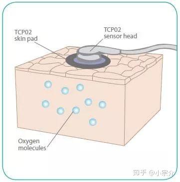 【看文献3】经皮二氧化碳分压监测