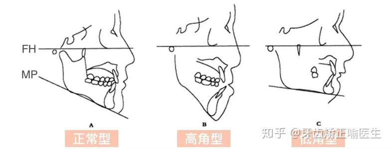 3,颌骨发育正常,但咬合平面过于倾斜,导致下颌平面相对面部的位置呈"
