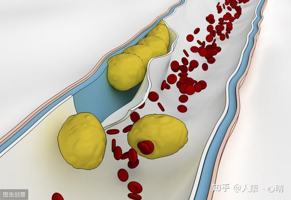 胆固醇高的危害