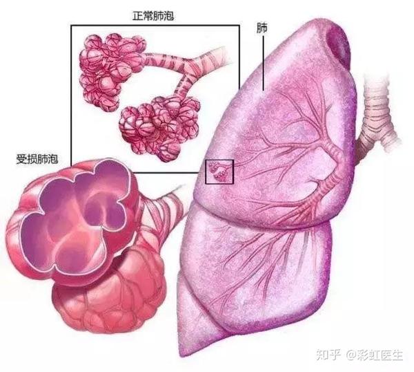 体检发现"肺大疱"怎么办?