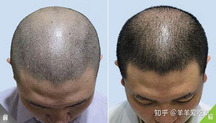 正常毛发密度为每平方厘米60-70根,种植后长出来的头发可最大接近原生