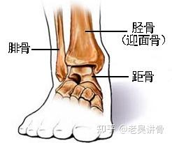 踝关节结构        踝关节俗称"脚踝",由胫骨,腓骨和距骨构成,胫骨和
