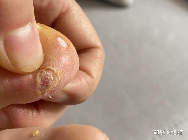 脚上只跖疣大概两三年了. 之前冷冻过复发了. 后来买过pyq的野药.
