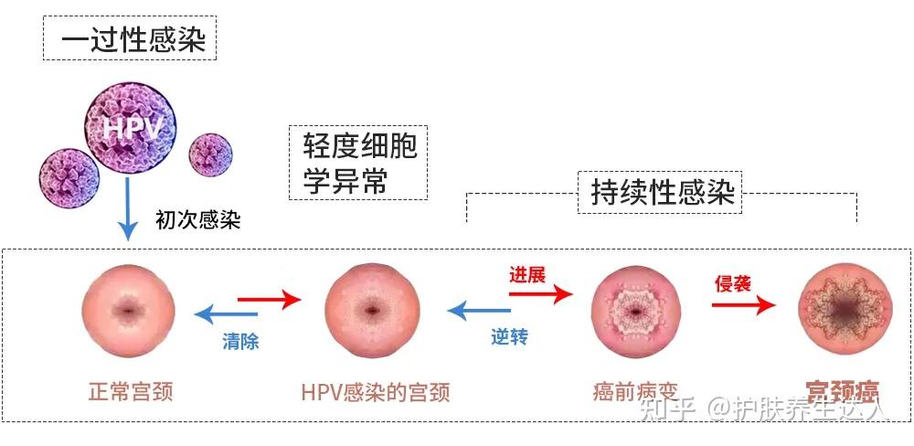 关于hpv你了解多少