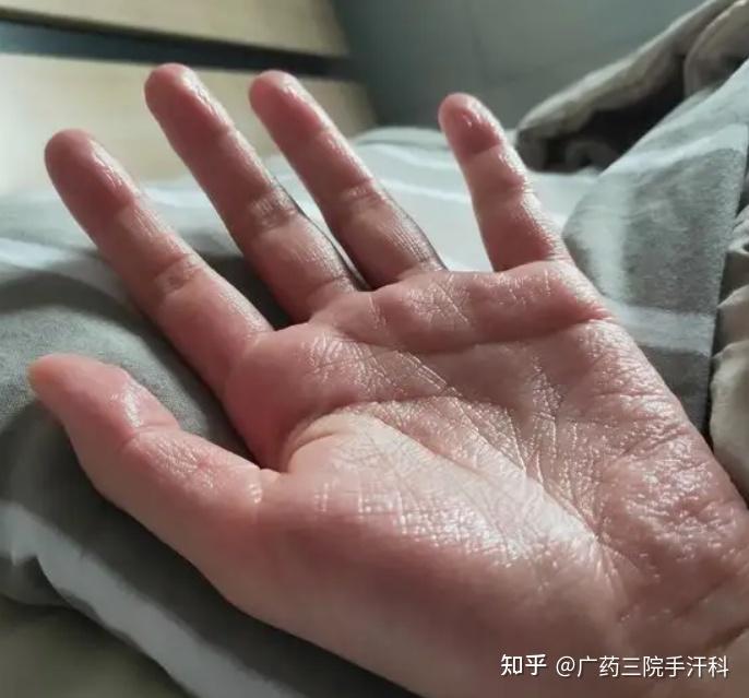 手脚心出汗 zhuanlan.zhihu.com