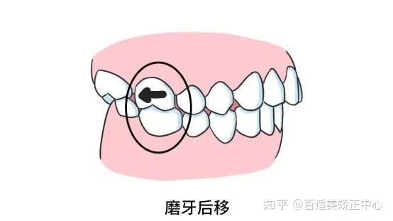 磨牙后推适用于轻度牙列拥挤和部分中度牙列拥挤的情况,有时还需配合