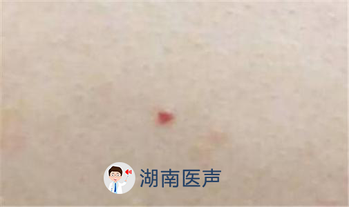 密麻麻的红色小点,又不知道是为什么,看着又很不舒服,担心是不是皮下