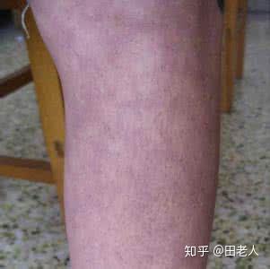 网状青斑,一种血管性疾病,网状青斑是一种由于皮肤局部血管舒缩功能