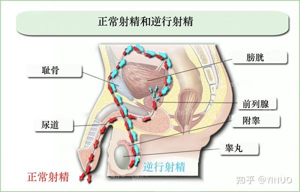 什么是无精症,逆行射精—无精症科普(二)