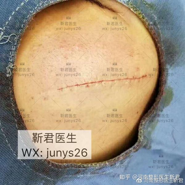 不留疤的缝合技术是怎样?