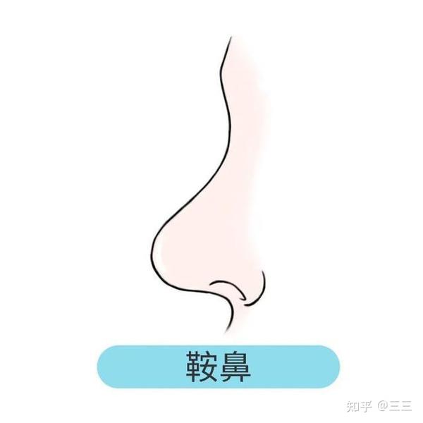 01鞍鼻(塌鼻梁)
