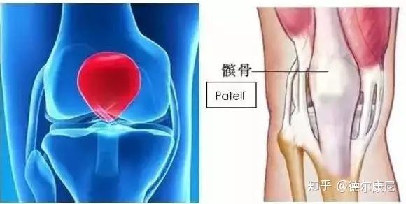 髌骨爪内固定 髌骨爪能进医保