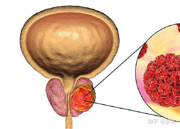 男人身体出现这3个异常前列腺或已伤透别硬拖成前列腺癌