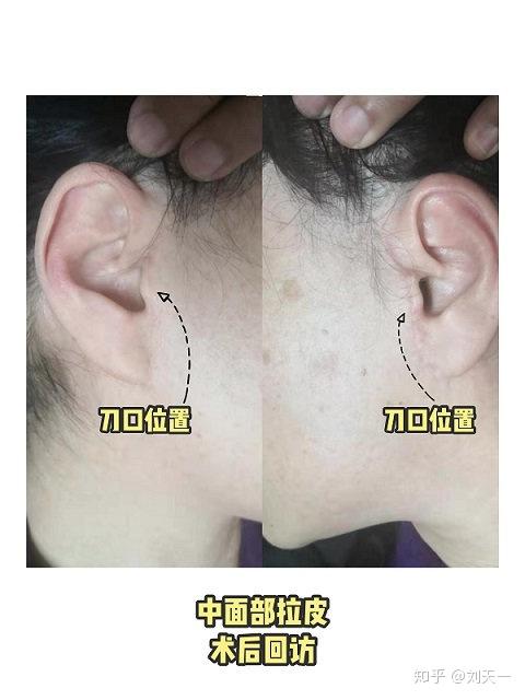 (图二)成功的中面部拉皮-愈合后的痕迹,平整,自然,无突起,耳朵形状