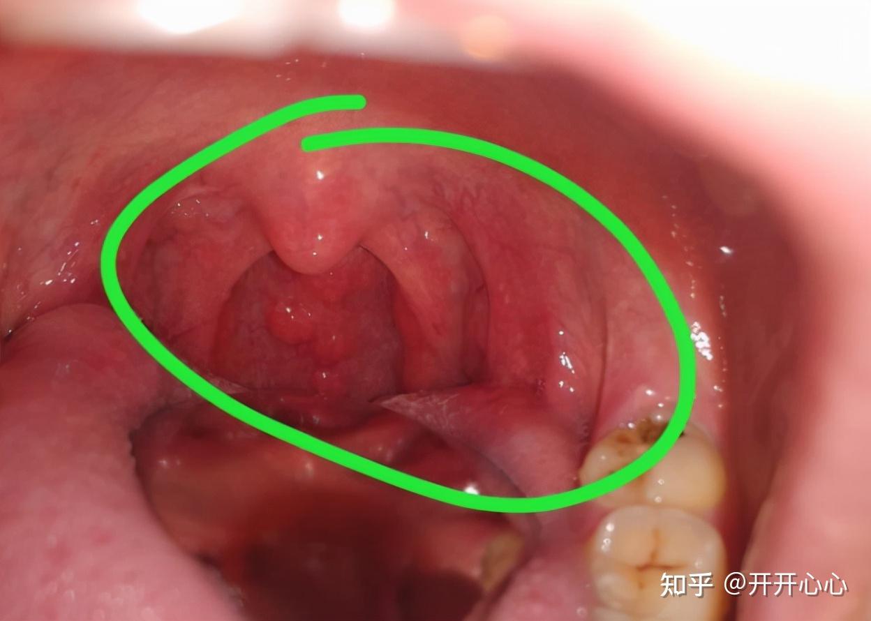 54岁男子感染hpv喉咙长菜花子女得知原因纷纷摔门离开