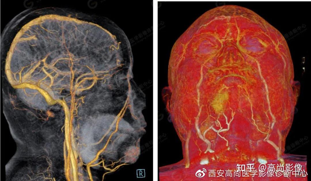 西安高尚病例颌面部血管畸形ctactv成像技术应用