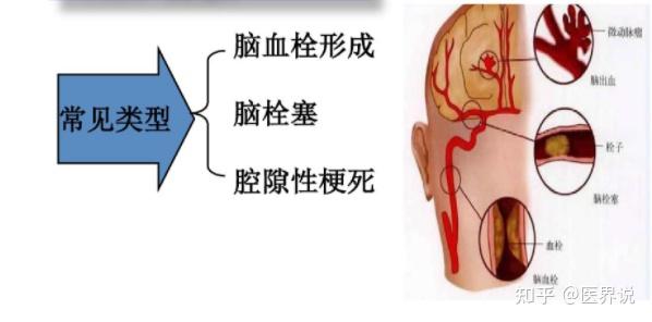 名称 脑梗塞(脑梗死) 是否医保 否 发病部位 颅脑  血液血管 挂号科室